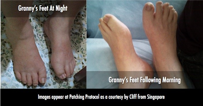 LifeWave Patches And Water Retention Case Images