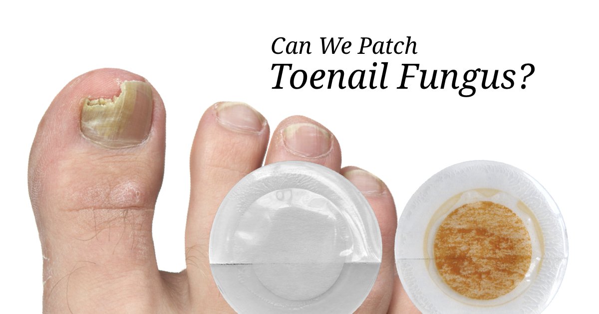 Approaching Toenail Fungus with Lifewave Patches